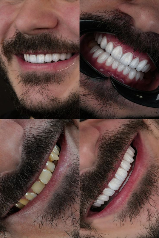 Carillas y Diseño de Sonrisa